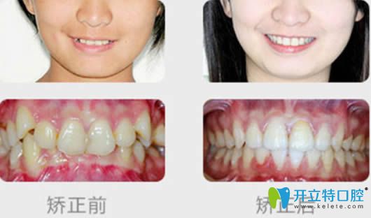 隐适美矫正价格揭秘，小巷深处的隐形魅力费用探讨